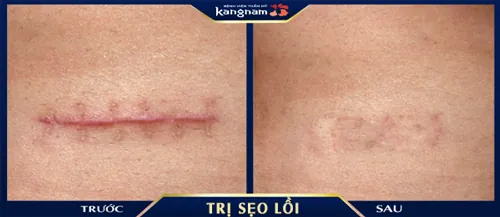 Hình ảnh kết quả trị sẹo sau khi khâu của khách hàng tại Kangnam
