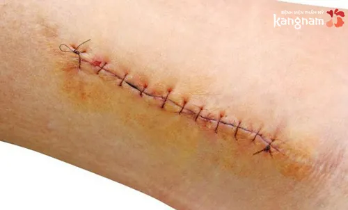 Nên trị sẹo vết khâu ngay khi vết thương bắt đầu lên da non