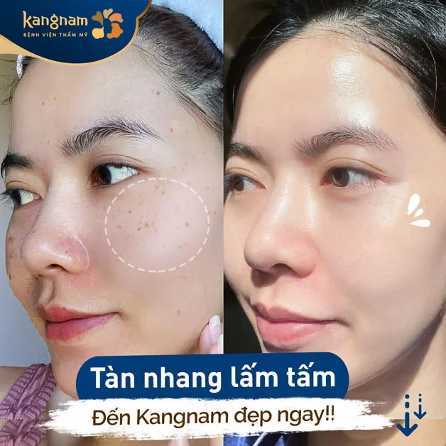 Điều trị tàn nhang hiệu quả tại Kangnam