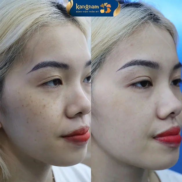 Chỉ với 1 liệu trình, xóa sạch tận gốc chân tàn nhang