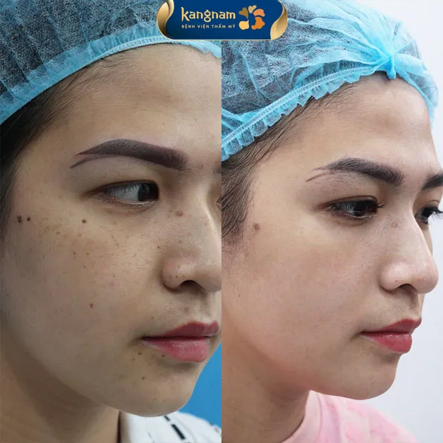 Tàn nhang lâu năm được loại bỏ triệt để