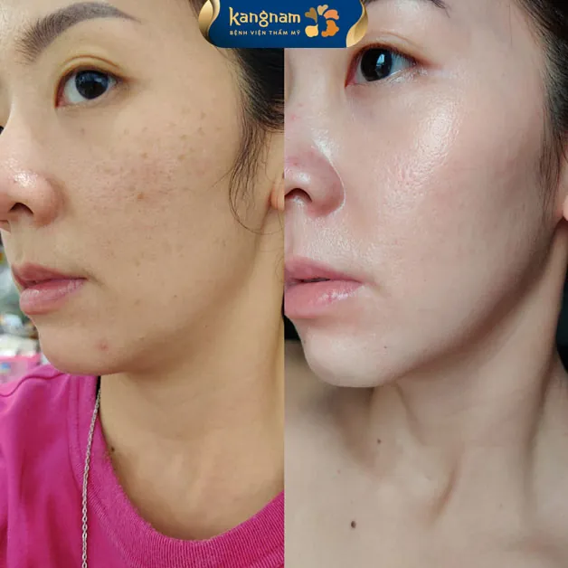 Lấy lại làn da sáng mịn sau khi bắn laser trị tàn nhang