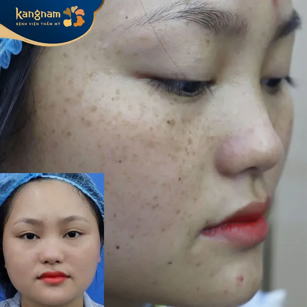 Bạn khách sở hữu làn da mịn màng, sáng khỏe sau 1 liệu trình trị tàn nhang