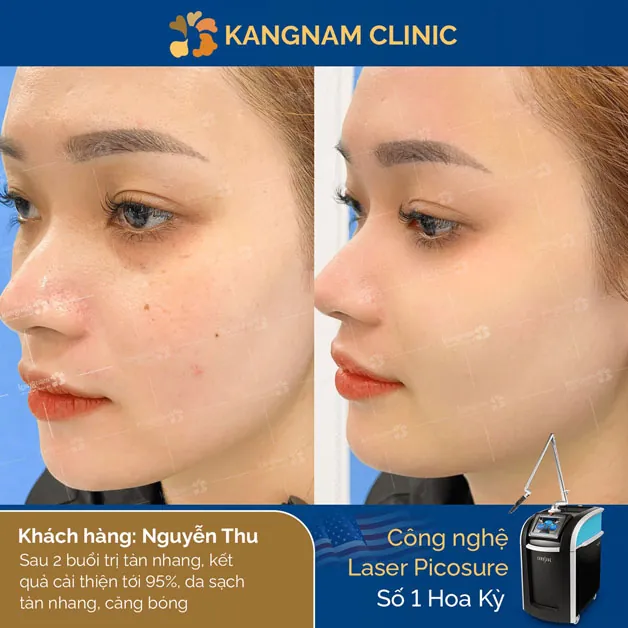 Công nghệ trị tàn nhang số 1 Hoa Kỳ