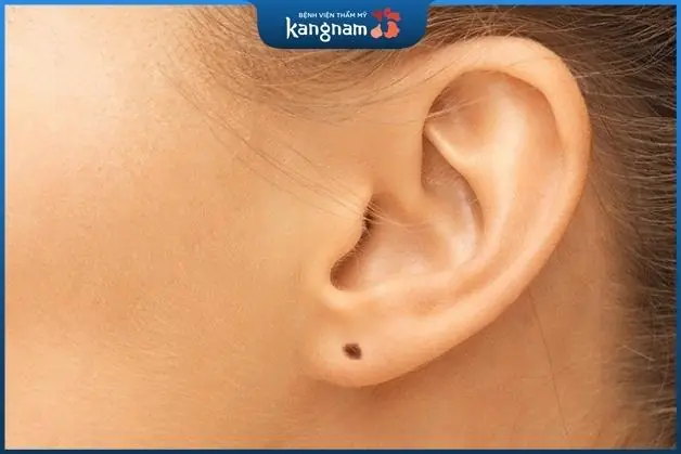 Có nên tẩy nốt ruồi ở tai không?