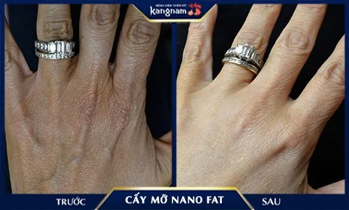 Hình ảnh đôi bàn tay của khách hàng căng đầy, trắng sáng, tươi trẻ sau khi trẻ hóa da tại Kangnam da tay bị nhăn nheo