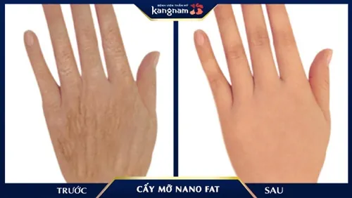 Trẻ hóa đôi tay bà già trờ thanh đôi mươi chỉ sau 20 phút thực hiện cấy mỡ Nano Fat da tay bị nhăn
