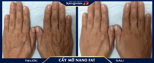 Đôi bàn tay khô nhăn được cải thiện toàn bộ sau khi cấy mỡ da tay khô nhăn nheo