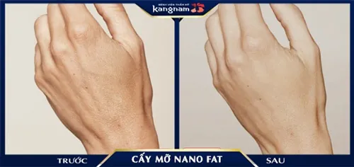 Vùng da tay nhăn biến mất hoàn toàn, thay thế vào đó là đôi tay căng đầy như tuổi đôi mươi da tay nhăn