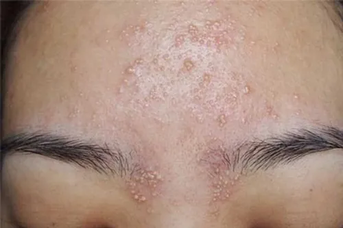 dị ứng mực phun