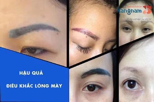 hậu quả điêu khắc lông mày