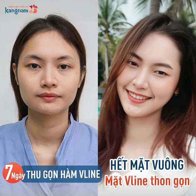 Mặt vuông có nên độn cằm?