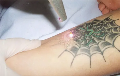 xoá xăm nên kiêng ăn gì