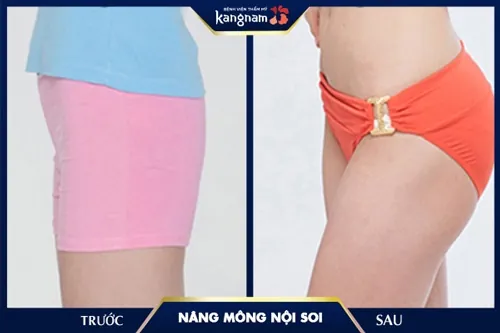 nâng mông giá bao nhiêu