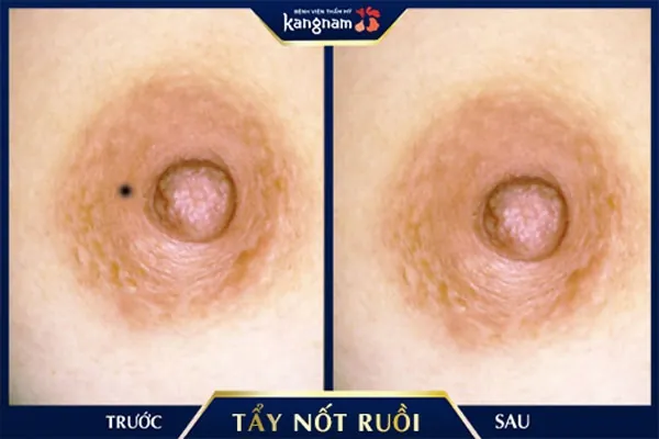 nốt ruồi ở quầng nhũ hoa