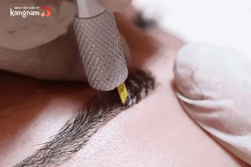 phun lông mày bị sưng