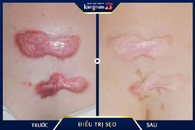 Tiêm trị sẹo lồi sau khi bị tai nạn khâu mổ
