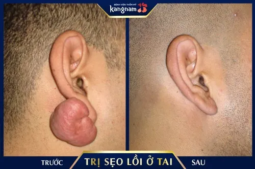 sẹo lồi ở vành tai