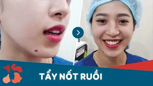 Laser CO2 Fractional có thể phá bỏ toàn bộ những đốm mụn ruồi lớn, lồi thịt phức tạp