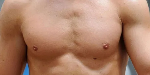 nốt ruồi ở dưới nhũ hoa 