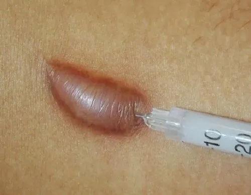 Tiêm thuốc có thể làm giảm tình trạng sẹo từ 70% - 80%