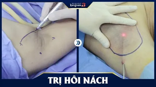 triệt lông nách có hết hôi nách