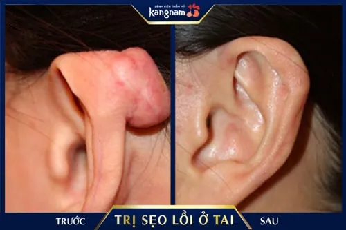 sẹo lồi ở vành tai