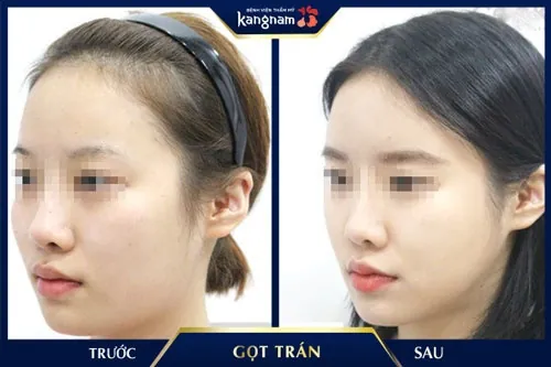 xem tướng qua trán