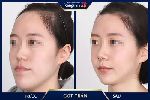 xem tướng trán vồ