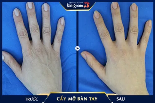 Cấy mỡ bàn tay giúp tay hết nhăn nheo cách loại bỏ nếp nhăn trên tay