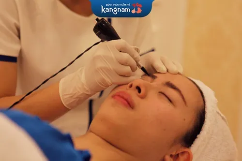 xóa xăm lông mày bằng laser