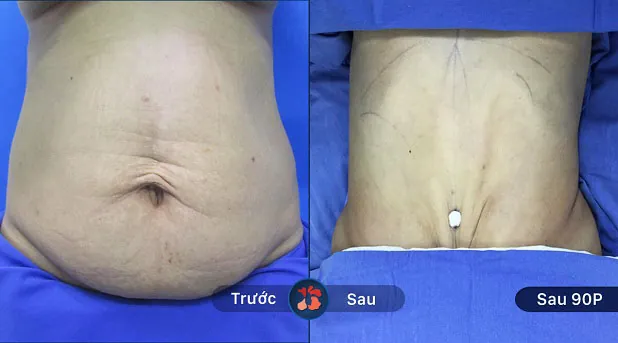 Khách hàng hút mỡ bụng chỉ sau 90 phút