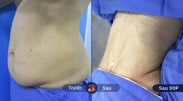 Bụng trở nên thon gọn và đẹp hơn sau khi khách hàng hút mỡ bụng tại Kangnam