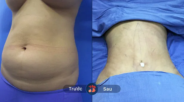 Kết quả trước và sau khi khách hàng hút mỡ 