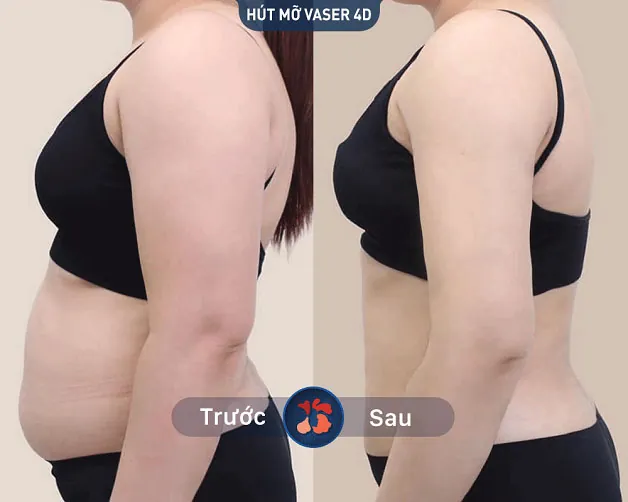 Khách hàng sau khi hút mỡ bụng tại Kangnam