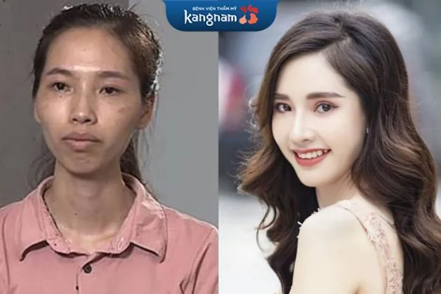 Sở hữu cặp mắt bồ câu hài hòa, tạo điểm nhấn nổi bật cho gương mặt sau phun mí mở tròng