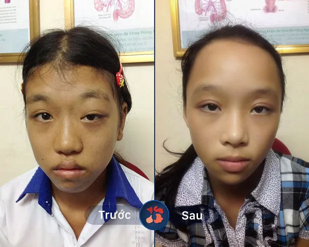 Chữa sụp mí mắt cho em bé 12 tuổi