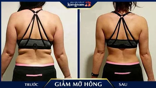 Kết quả trước và sau khi khách hàng hút mỡ hông tại Kangnam