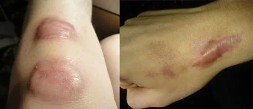 Các dạng sẹo ngã xe