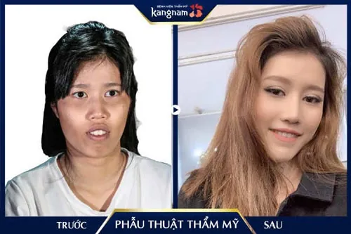 Ngô Quế An "lột xác" xinh đẹp nhờ PTTM có nên phẫu thuật thẩm mỹ