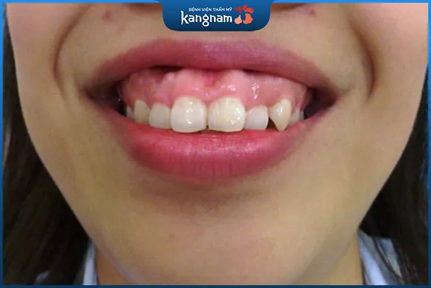 Nướu phì đại khiến hàm trên bị lộ nướu