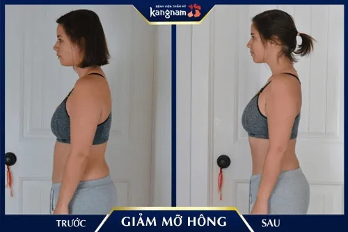 Ưu điểm giảm mỡ hông bằng công nghệ