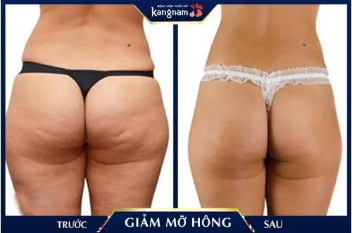 Hông trở nên thon gọn và đẹp hơn sau khi hút mỡ