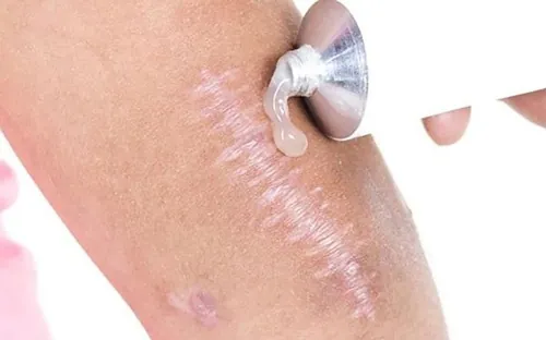 Sử dụng kem trị sẹo sau tai nạn 