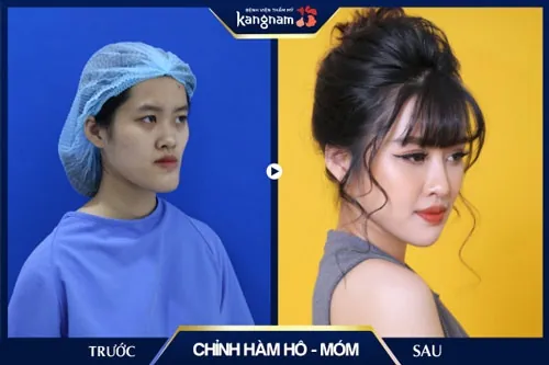 phẫu thuật thẩm mỹ da mặt mụn