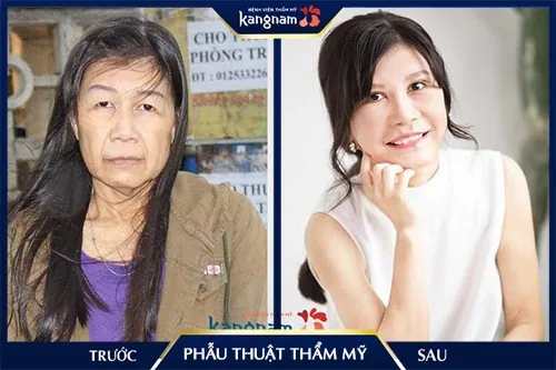 phẫu thuật thẩm mỹ ở hàn quốc webtretho