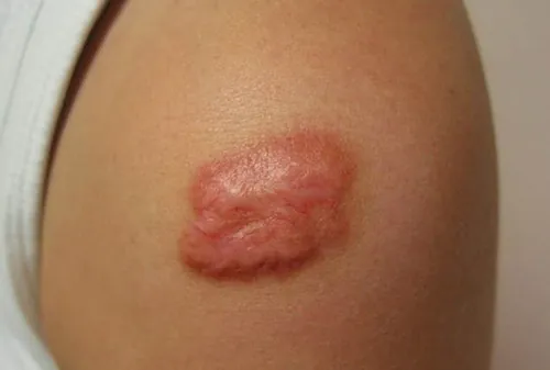 Hiểu rõ hơn về các sẹo lồi 