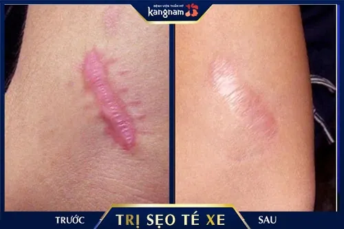 Kết quả trước và sau khi khách hàng trị sẹo tại Kangnam 