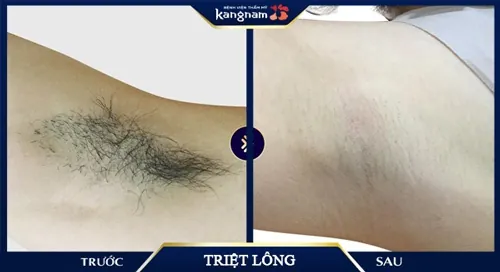 Lông nách dày rậm, đen cứng giờ không còn là nỗi lo của mình nữa - Chị Hòa (Hà Nội) chia sẻ tẩy lông nách