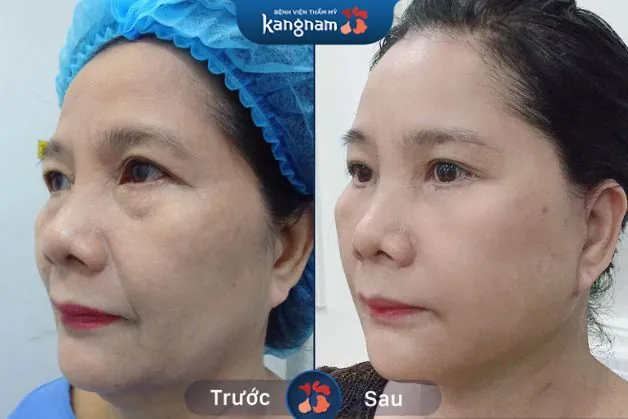 Toàn bộ nêp nhăn sâu khiến da mặt già nua chục tuổi đã được cải thiện, "xóa sổ" đến 90% Trẻ hóa an toàn tại Kangnam